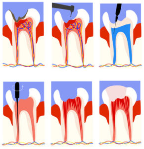 Endodontie / Wurzelbehandlung