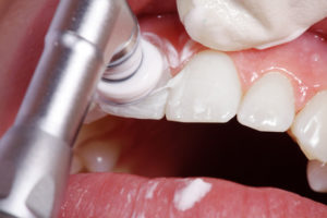 Prophylaxe Behandlung in der Zahnarztpraxis